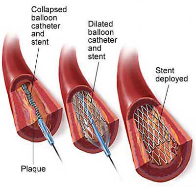 Cardiac vascular stent